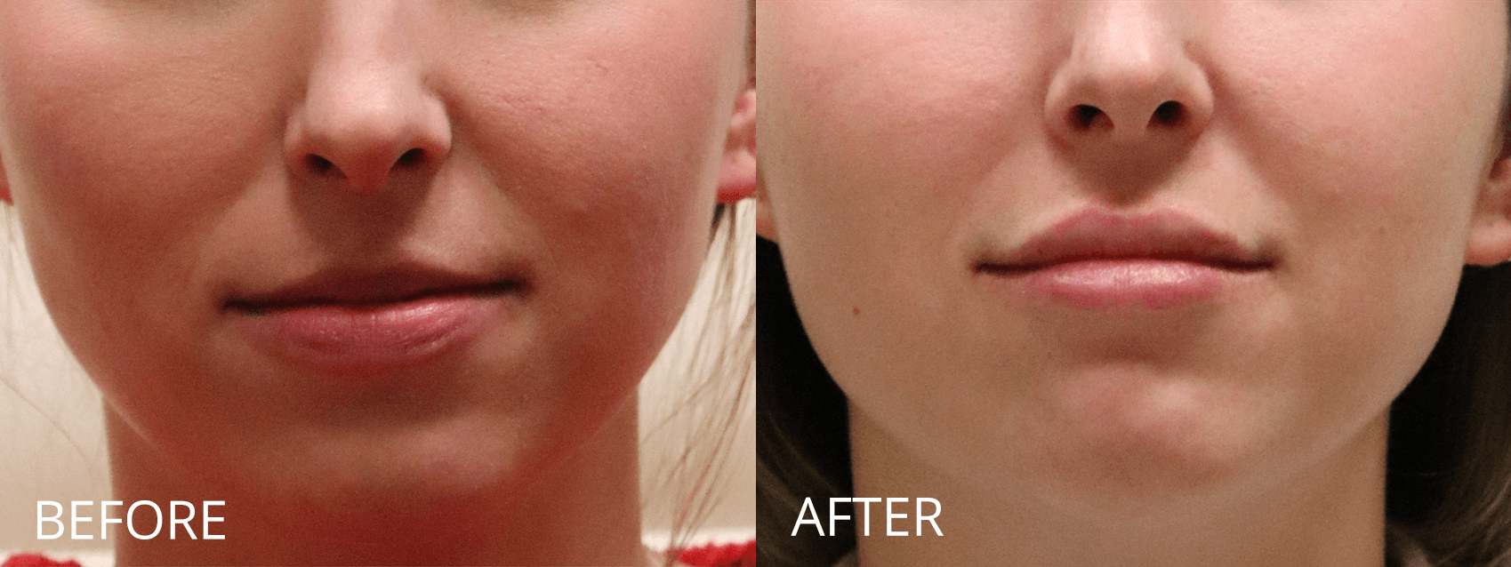 Botox And Fillers Before And Afters Raval Facial Aesthetics Denver